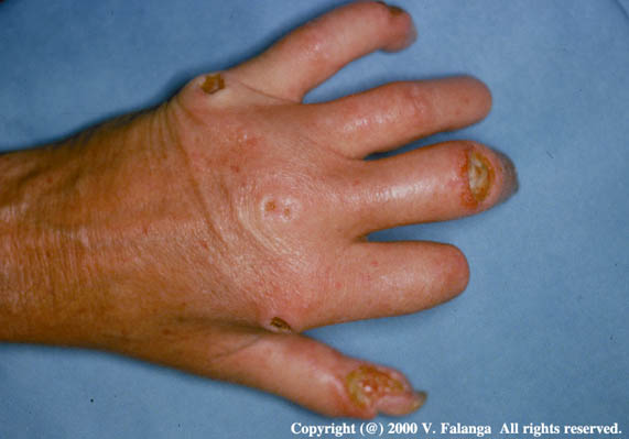 17. Scleroderma ulcers